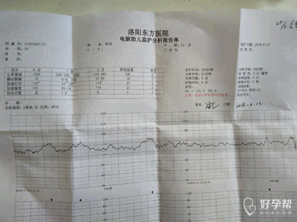 深入了解胎心监护ioco：孕期胎儿健监测新篇章
