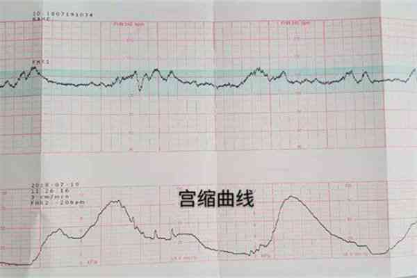 深入了解胎心监护ioco：孕期胎儿健监测新篇章