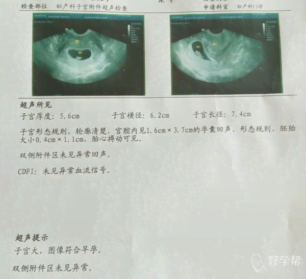 深入了解胎心监护ioco：孕期胎儿健监测新篇章