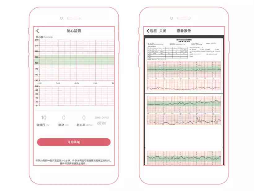 胎心监护仪ai报告是什么