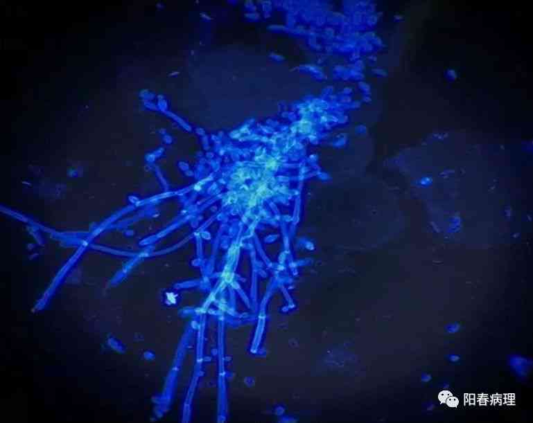 真菌荧光镜检操作流程：实与阳性结果含义解析