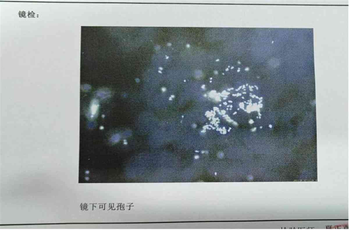真菌荧光镜检操作流程：实与阳性结果含义解析