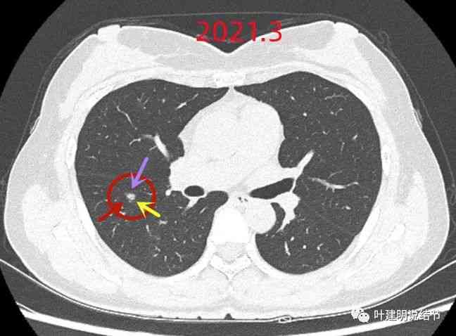 AI辅助检测报告单中结节解析：深入探讨结节含义与影响