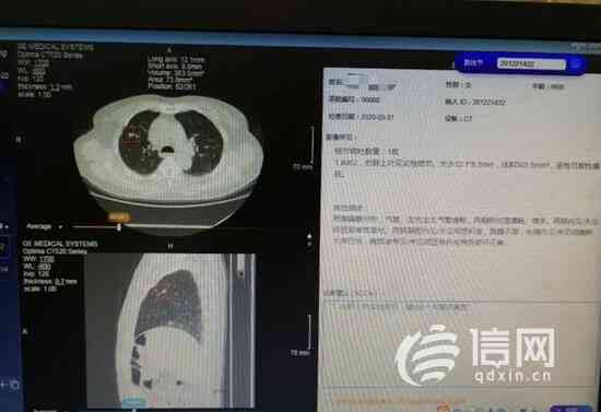 智能胃镜报告单分析系统AI