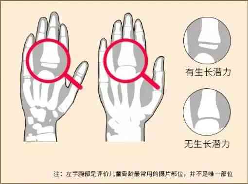 深度解析：骨龄报告准确性及对孩子未来身高预测的影响