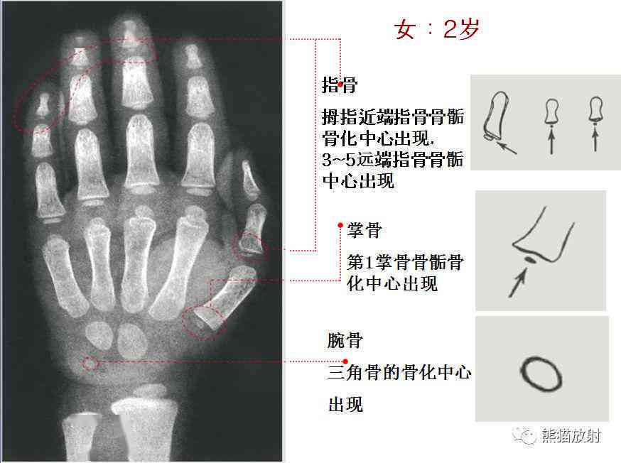深度解析：骨龄报告准确性及对孩子未来身高预测的影响