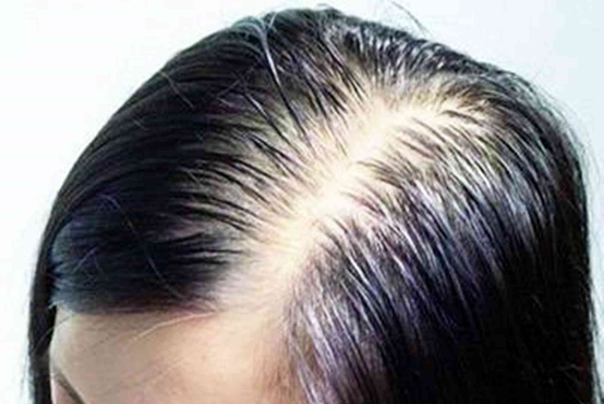 脱发烦恼：我的小型脱发奋斗记