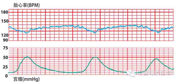 胎心监护ioco是什么：胎心监护e.uc、acceleration、ld、ltv的含义解析