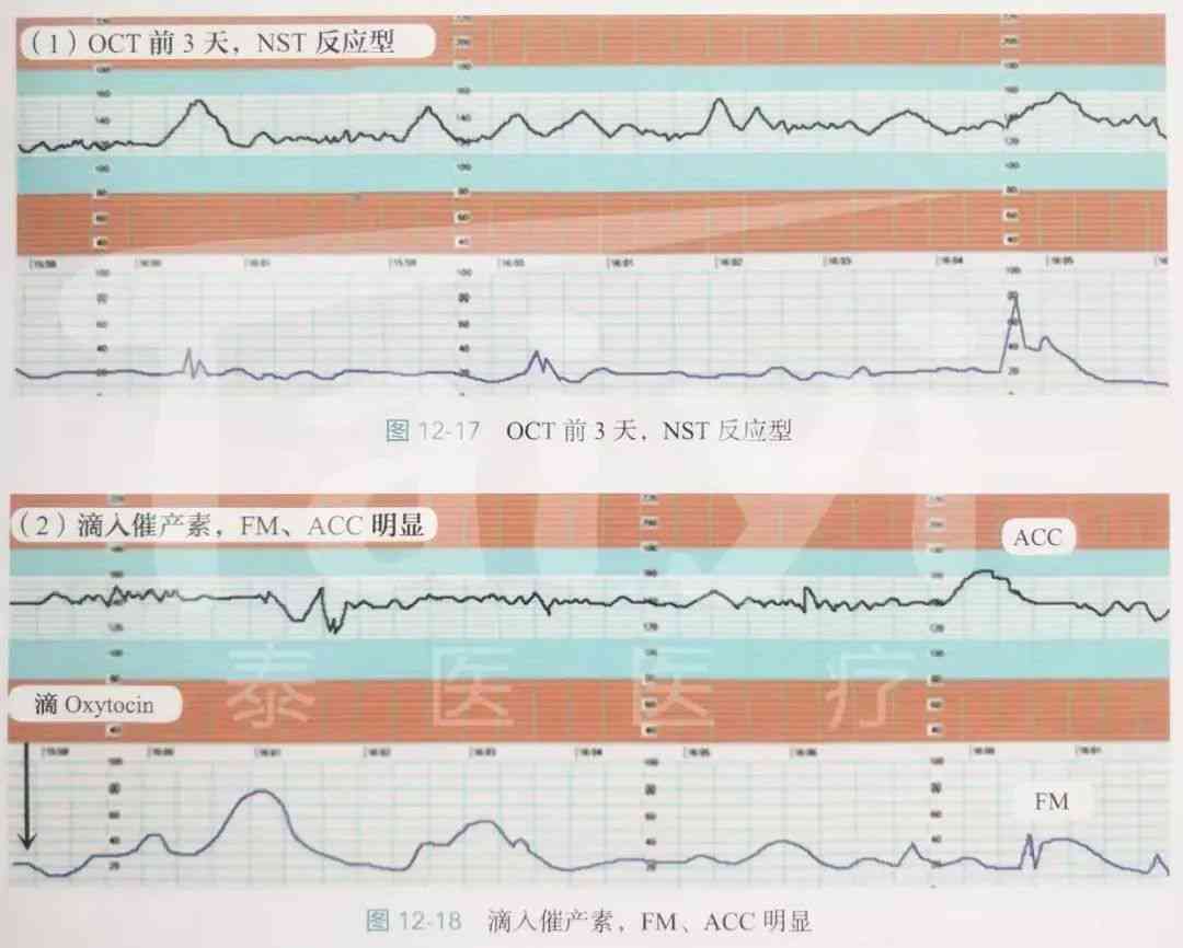 全面解读胎心监护报告：评价指标、图形分析、异常情况与应对策略