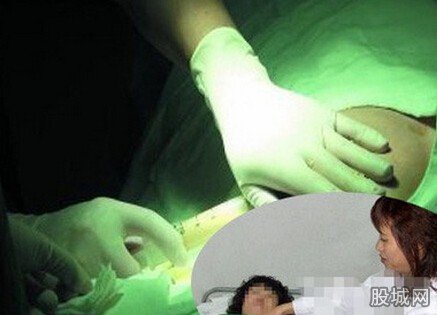 产妇隆胸后炸裂