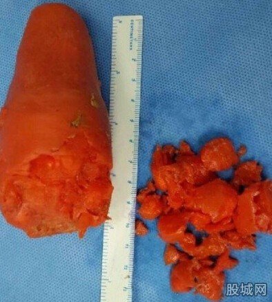 男子将萝卜捅入肛门
