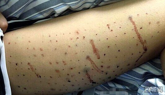 女孩腿上扎100个窟窿眼