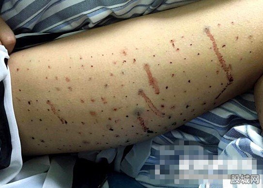 女孩为减肥腿上扎100个窟窿眼
