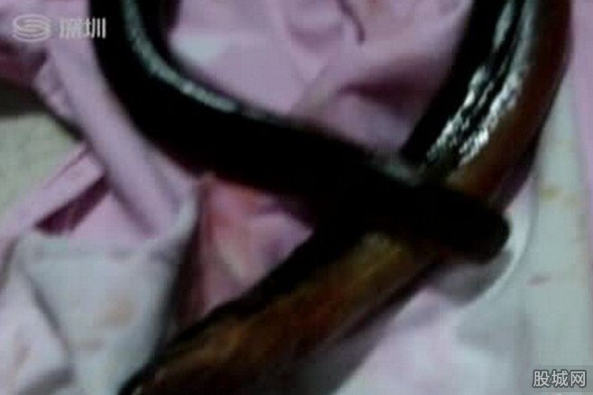 男子被黄鳝钻肛门
