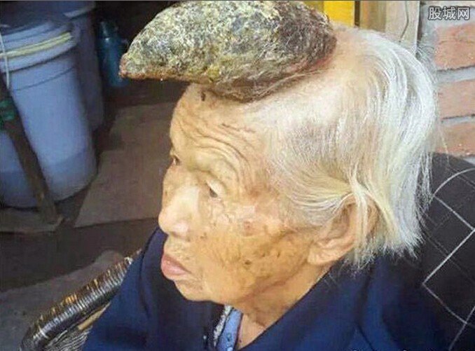 头上黑痣长成独角